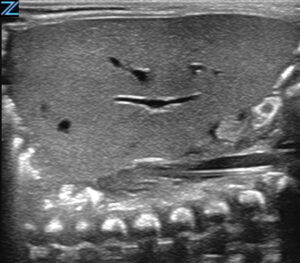 ZONE Sonography