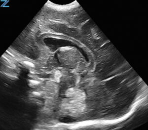 ZONE Sonography