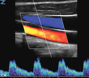 ZONE Sonography